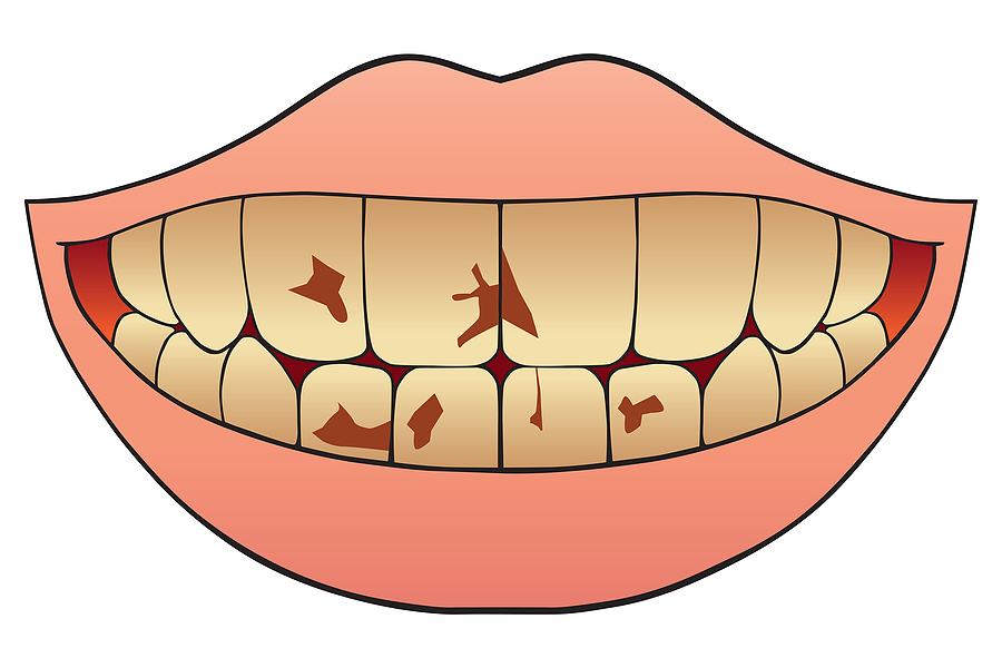 Fighting Plaque And Tartar Buildup