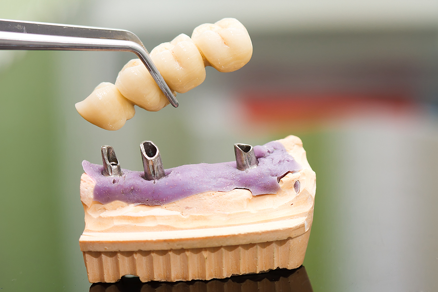 Are Dental Implants Right For You?