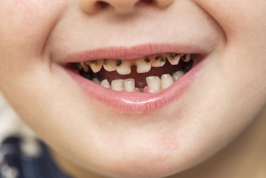 My Child Knocked Out A Tooth – What Can I Do?