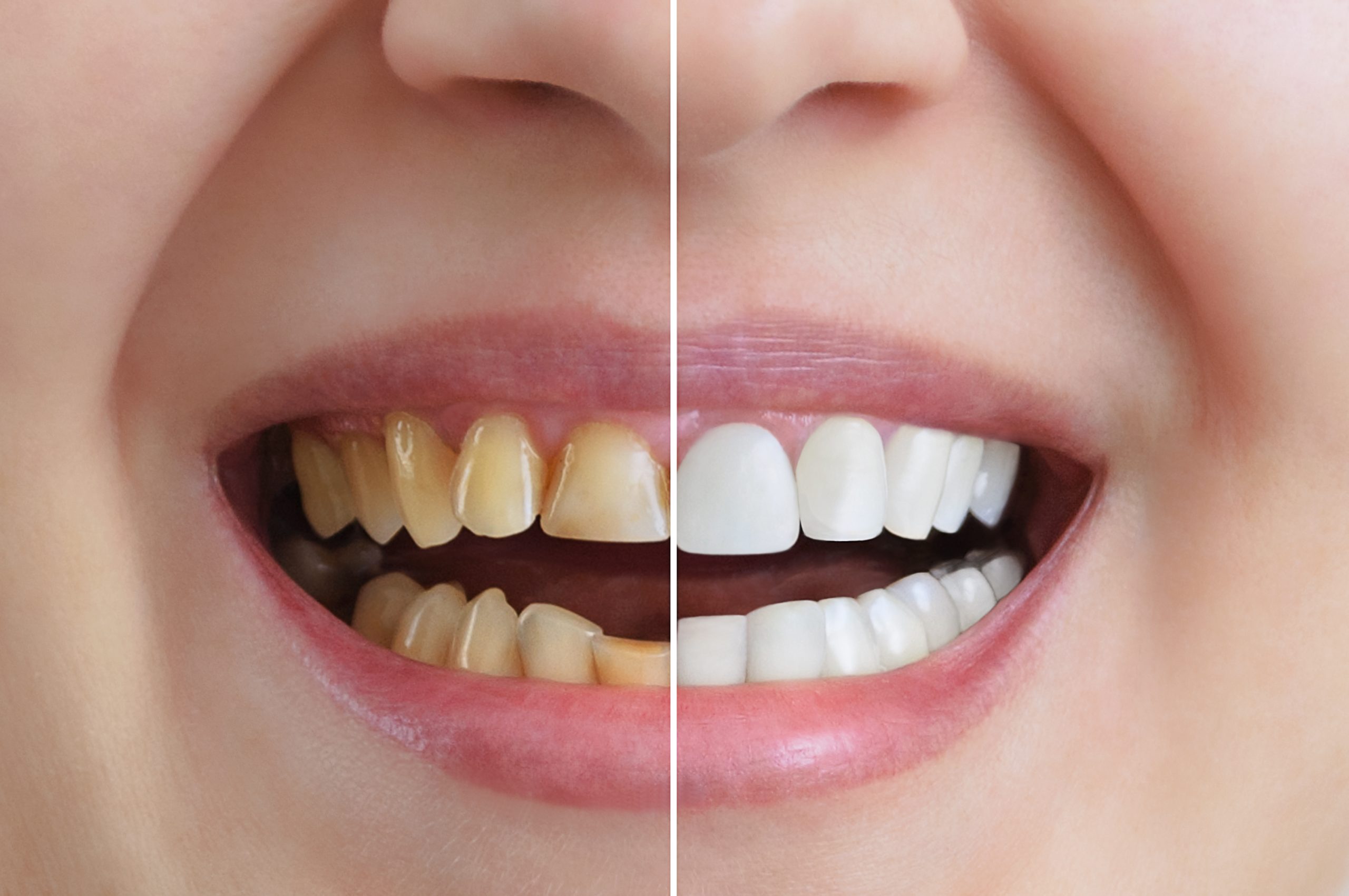 The Truth About Teeth Whitening